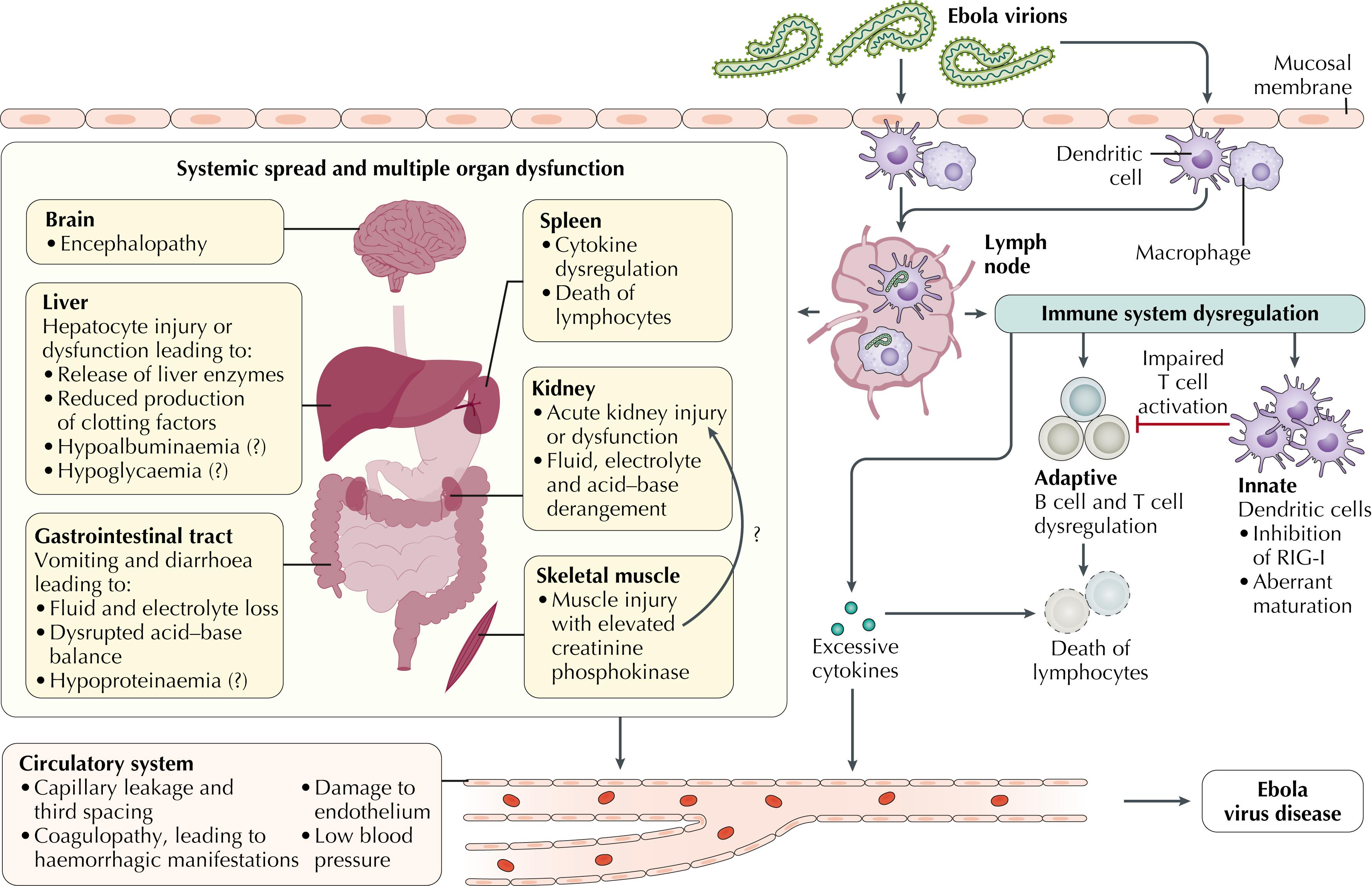 Fig. 94.2, Conceptualized pathogenesis of Ebola virus disease. Ebola virus particles enter the body through dermal injuries (microscopic or macroscopic wounds) or via direct contact via mucosal membranes. Primary targets of infection are macrophages and dendritic cells. Infected macrophages and dendritic cells migrate to regional lymph nodes, producing progeny virions. Through suppression of intrinsic, innate, and adaptive immune responses, systemic distribution of progeny virions and infection of secondary target cells occur in almost all organs. Key organ-specific interactions occur in the gastrointestinal tract, liver, and spleen, with corresponding markers of organ injury or dysfunction that correlate with human disease outcome. The question marks indicate speculated manifestations. RIG-I, Antiviral innate immune response receptor RIG-I.