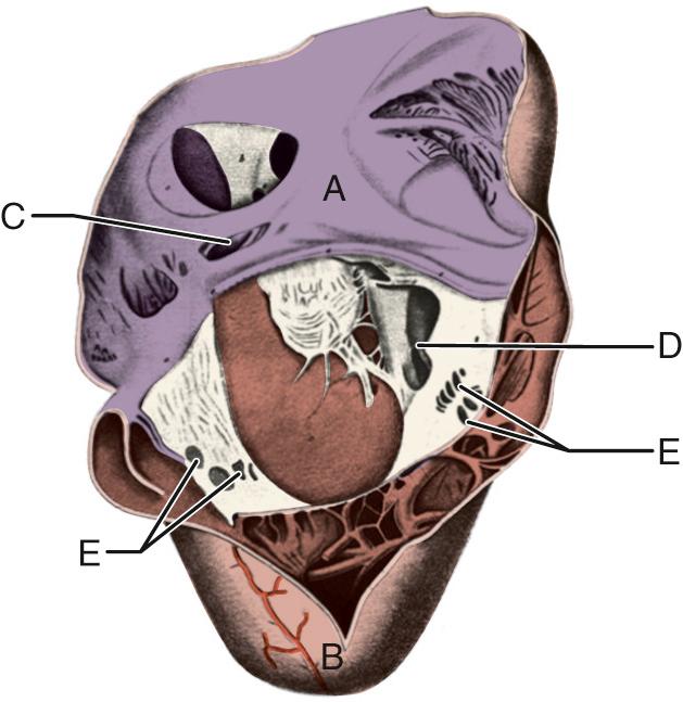 FIGURE 130-1, Figure from the original Ebstein anomaly case report. The right atrium and right ventricle are shown opened along the right border beginning at the superior vena cava. A, Right atrium; B, right ventricle; C, rudimentary septal leaflet of tricuspid valve with its chordae tendineae, which insert on the endocardium of the ventricular septum; D, opening through which one can get into the right conus arteriosus, and in the opposite direction, one can get into the sac that is formed by membrane; E, fenestrations seen in the tricuspid leaflets.