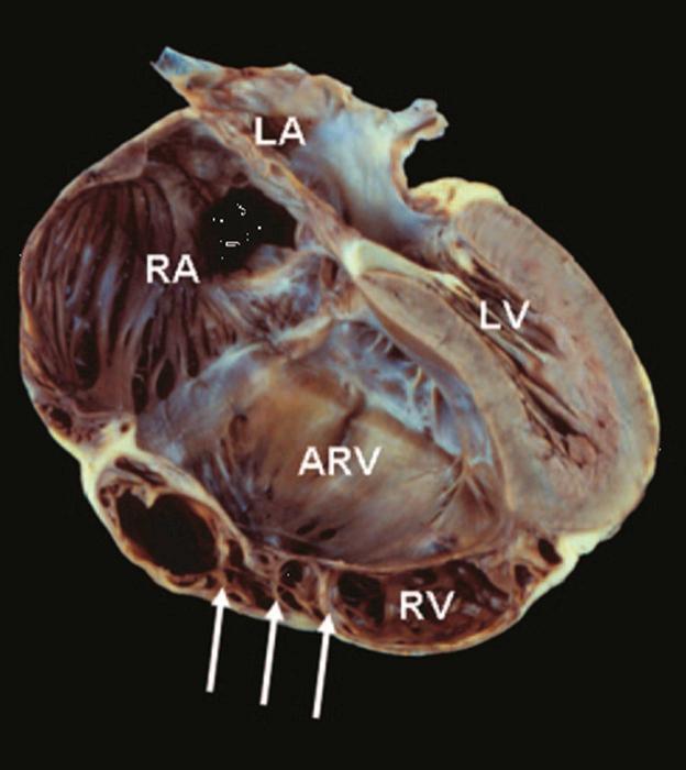 FIGURE 130-2, Severe Ebstein malformation of tricuspid valve (four-chamber view) showing marked downward displacement of shelflike posterior leaflet with attachment to underlying free wall by numerous muscular stumps (arrows), markedly dilated atrialized portion of right ventricle (ARV), small functional portion of right ventricle (RV), leftward bowing of ventricular septum, and marked dilation of right atrium (RA). LA, Left atrium; LV, left ventricle.