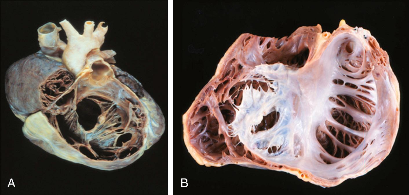 FIGURE 130-3, A and B, Ebstein heart: marked fenestrations and tethering of the tricuspid valve anterior leaflet.