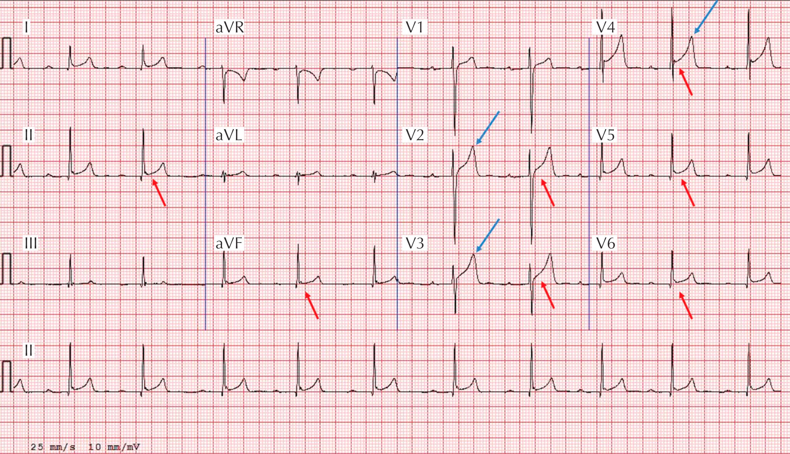 Figure 34.2, ECG demonstrating early repolarization (J-point and ST-segment elevation) in II, aVF, and V 4 –V 6 (red arrows) and tall, peaked T waves (blue arrows). These are common training-related findings in athletes and do not require more evaluation.
