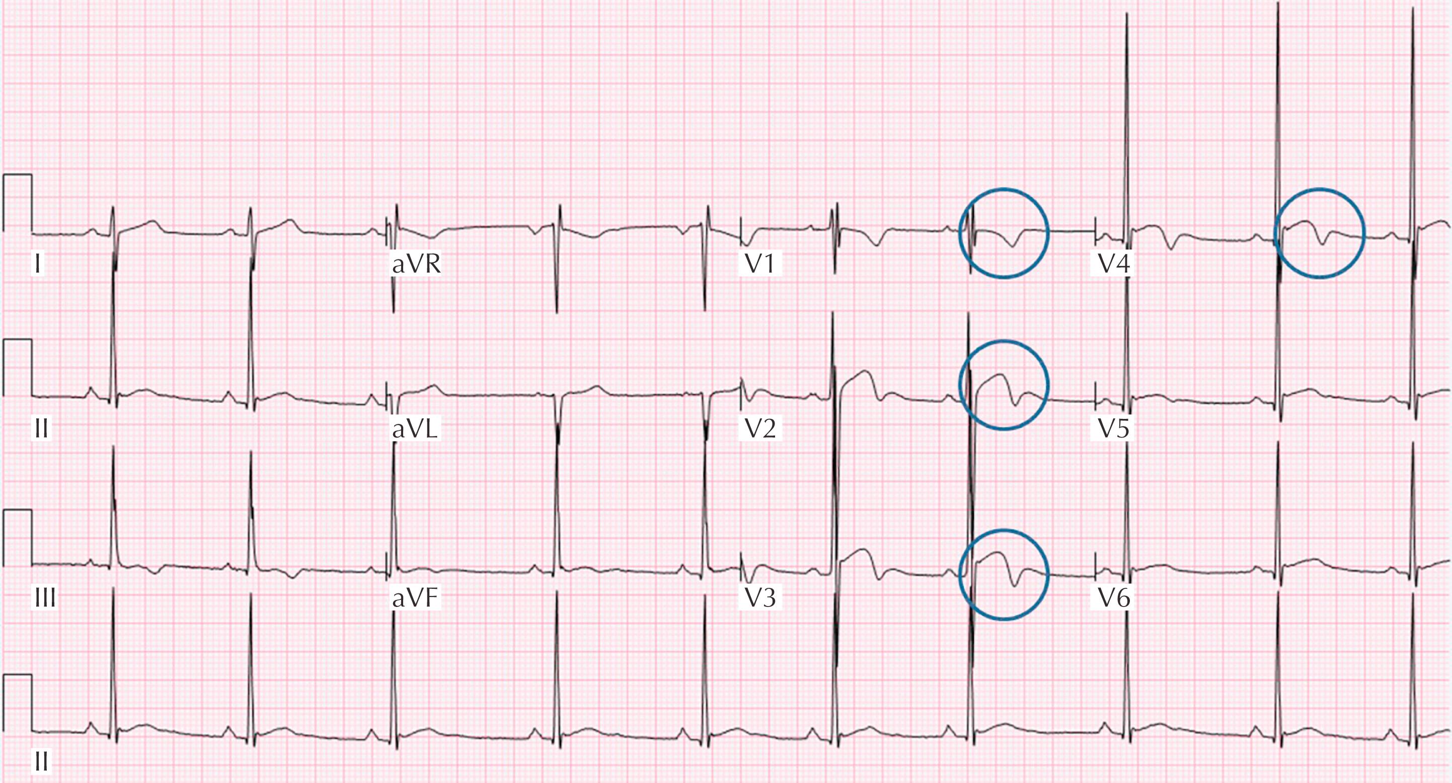 Figure 34.3, ECG from a 24-year-old asymptomatic black athlete. ECG demonstrates J-point elevation with a convex “domed” ST segment followed by T-wave inversion confined to leads V 1 –V 4 (blue circles). This is a normal repolarization variant in black athletes.