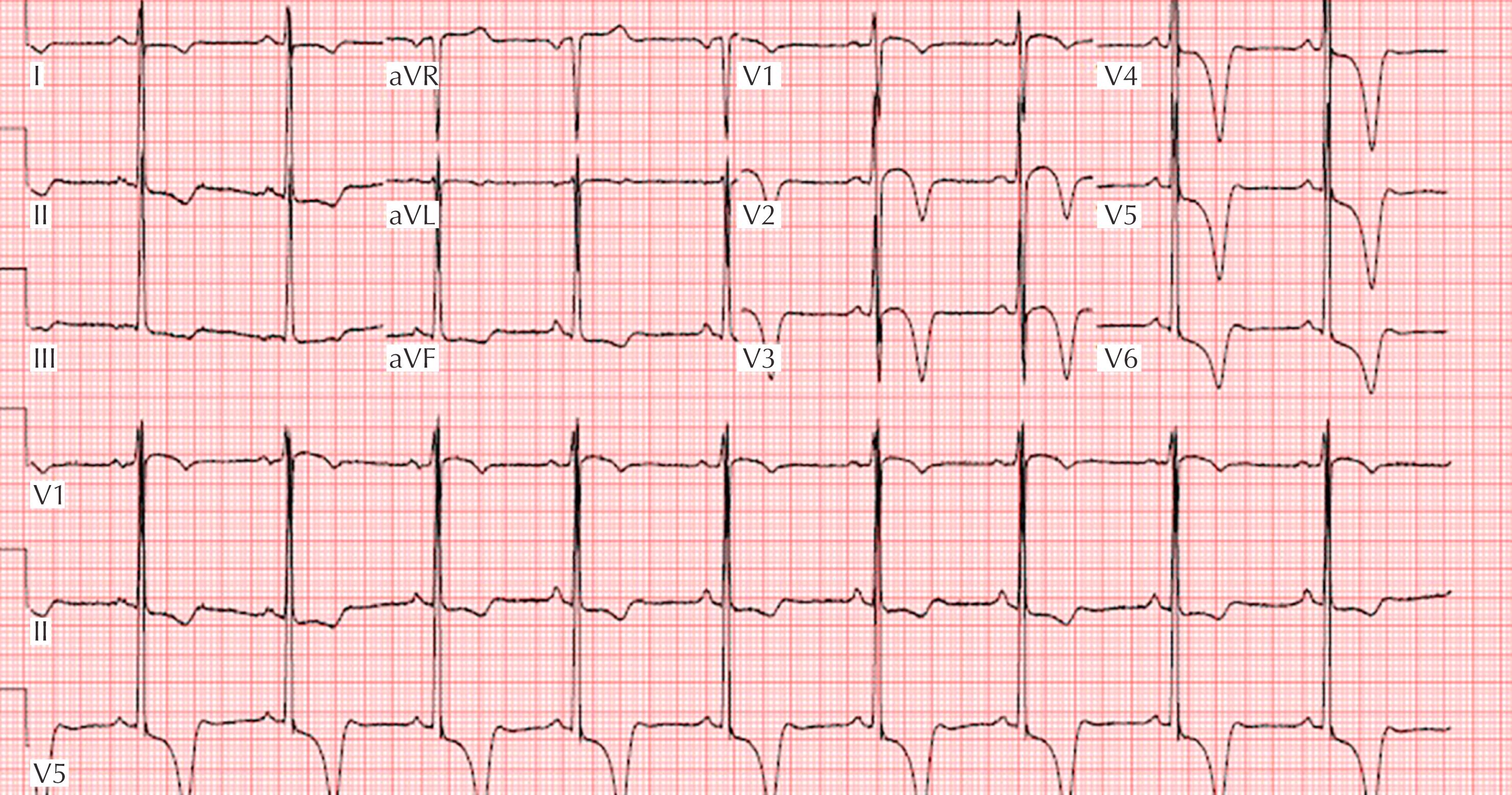 Figure 34.4, ECG from a patient with hypertrophic cardiomyopathy demonstrates deep T-wave inversion and ST-segment depression predominantly in the lateral precordial leads V 4 –V 6 .