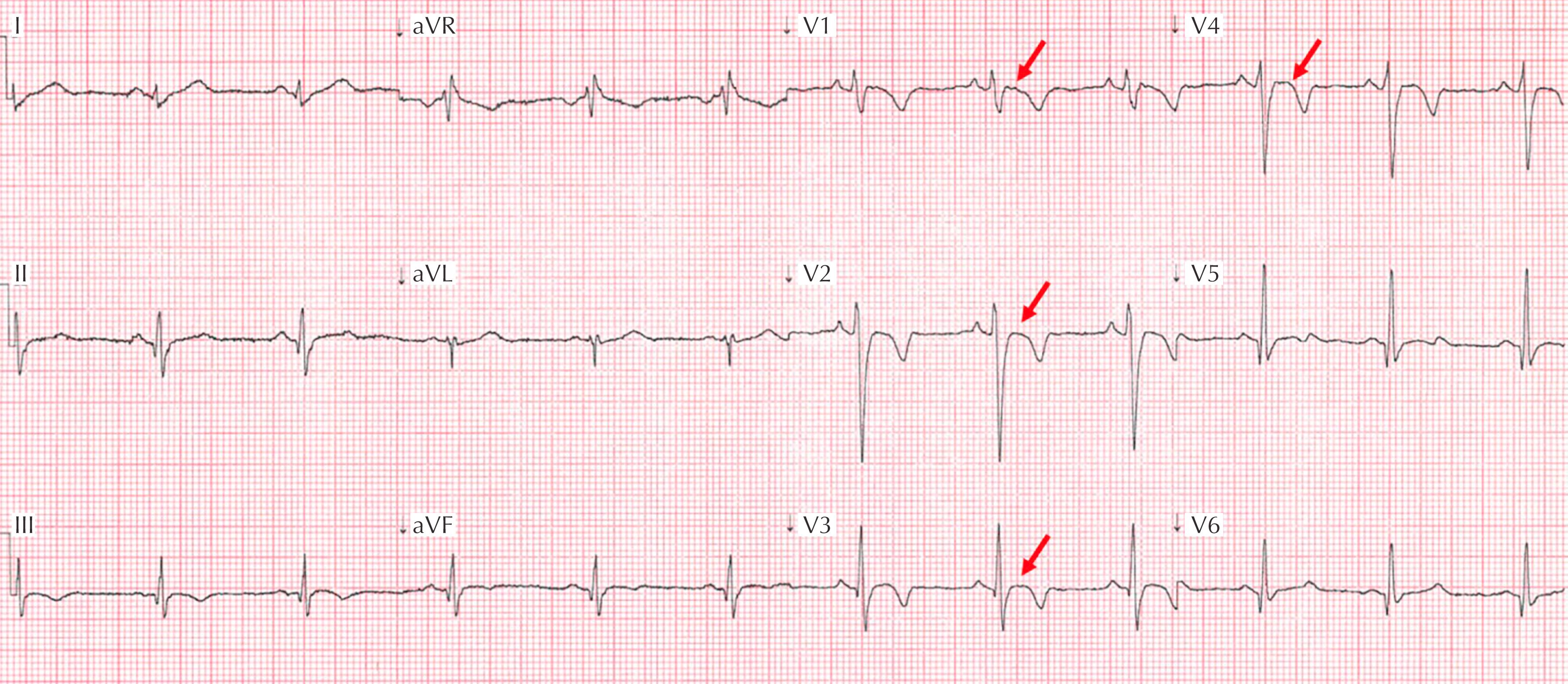 Figure 34.5, ECG with anterior T-wave inversions (V 1 –V 4 ) preceded by a nonelevated J-point and ST segment (red arrows) , suggestive of AC.