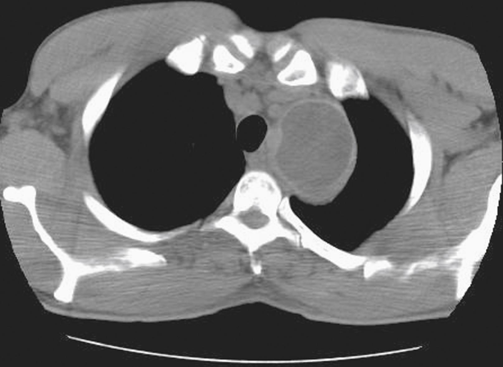 Fig. 85.2, Computed tomographic appearance of pulmonary cystic echinococcosis.