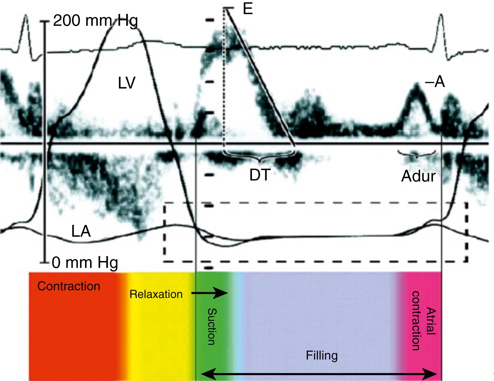 Figure 35.1, Mitral inflow represents pressure difference between the left ventricle and left atrium: simultaneous invasive pressure curves and Doppler echocardiography during the phases of left ventricular filling (relaxation, suction, filling, and atrial contraction). A, Mitral filling at atrial contraction; Adur, duration of mitral A wave; DT, mitral deceleration time; E, mitral early filling wave; LA, left atrial pressure curve; LV, left ventricular pressure curve.