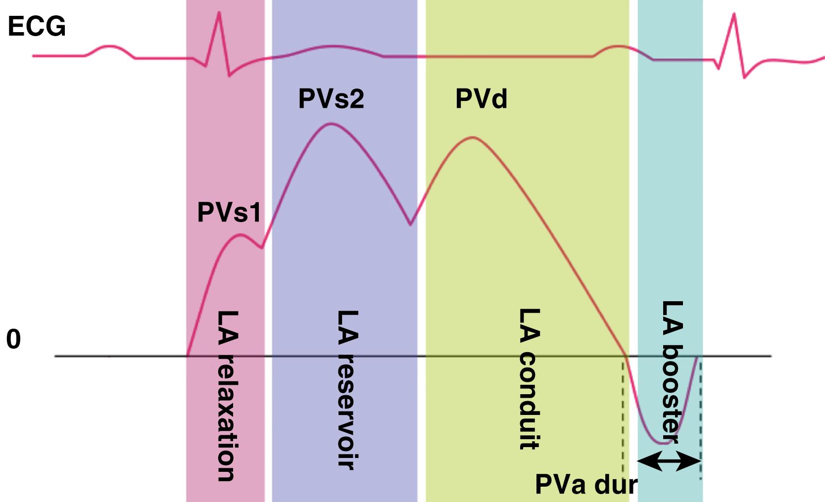 Figure 35.2, Pulmonary vein (PV) flow, corresponding to left atrial (LA) function. ECG, electrocardiogram; PVs1, early systolic pulmonary vein flow; PVs2, late systolic pulmonary vein flow; PVd, diastolic pulmonary vein flow; PVa dur, duration of peak reverse flow velocity at atrial contraction.