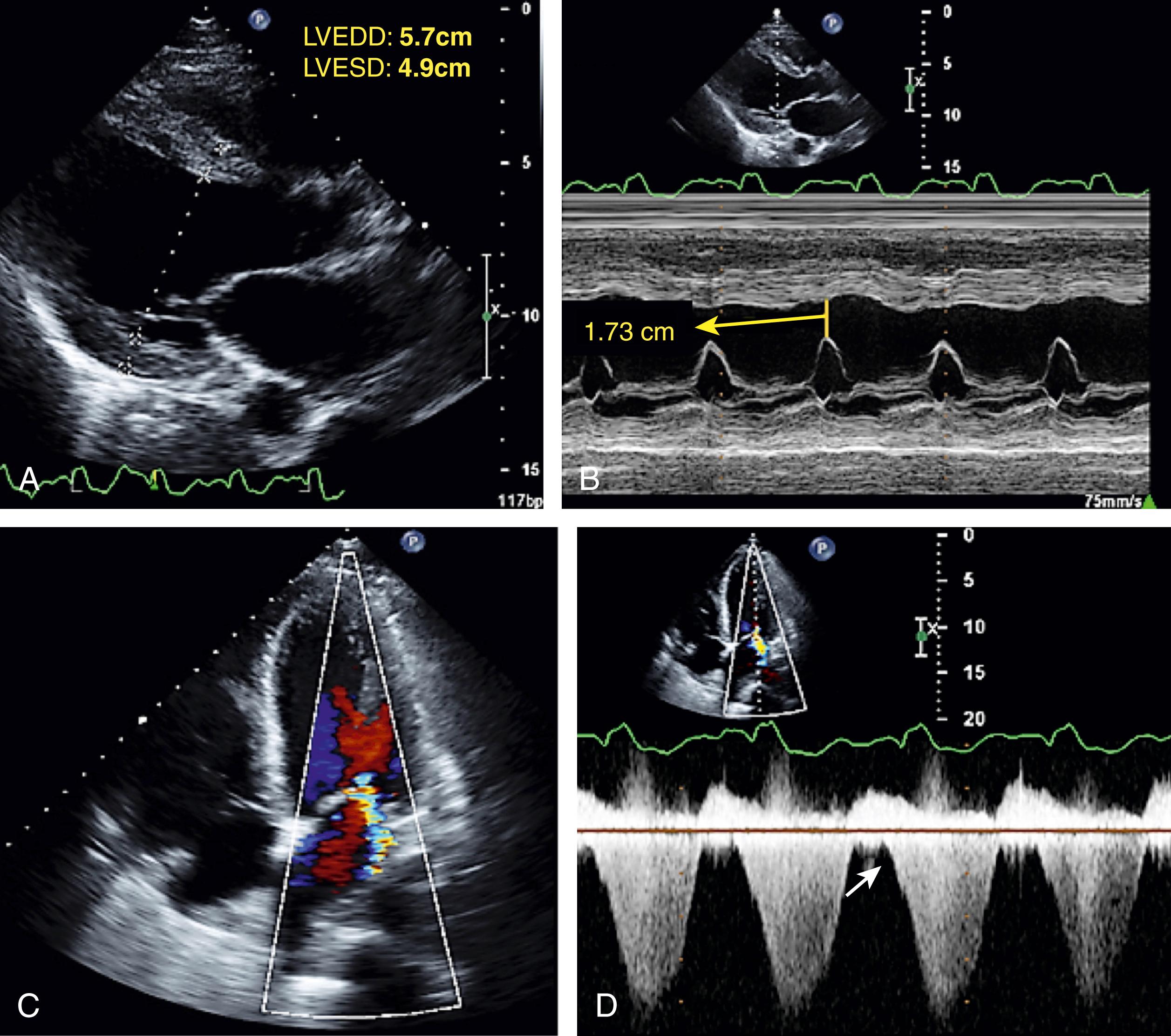 Figure 65.1, Transthoracic echocardiography image of a 33-year-old patient with no significant past medical history that presented with acute pulmonary congestion and elevated cardiac biomarkers. A, Long-axis view revealed a dilated left ventricle (LV) with global LV hypokinesis, LV ejection fraction (LVEF) of 25%, and a severe right ventricular dysfunction B, M-mode imaging showing E-point septal separation of 1.73 cm, consistent with reduced LV contractility and LVEF. C, Apical four-chamber view with color Doppler showing moderate to severe functional mitral regurgitation (MR) with a posteriorly directed wall-hugging MR jet. D, Continuous-wave (CW) spectral Doppler showing MR with a diastolic MR component (white arrow) caused by acute elevation in LV filling pressures. The patient’s LV function gradually improved with medical treatment of his congestive heart failure. LVEDD, Left ventricular end-diastolic diameter; LVESD, left ventricular end-systolic diameter. (See accompanying Video 61.1A , Video 61.1C .)