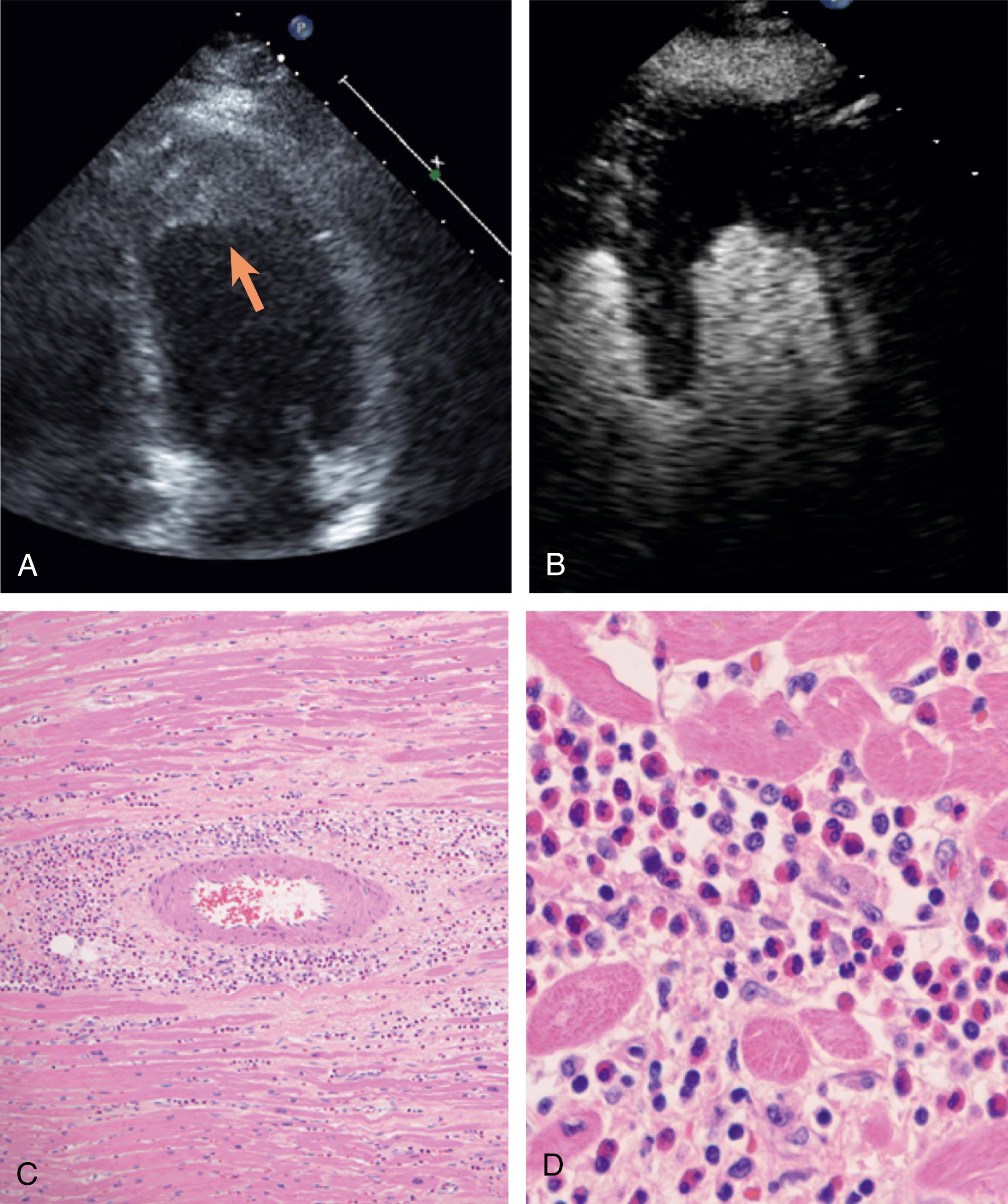 Figure 65.2, Transthoracic echocardiography image of a 65-year-old woman who presented with multiple embolic brain infarcts. Her white blood count showed a differential consisting of 58% eosinophils. A, Apical four-chamber view showing prominent left ventricular apical thickness consistent with a subendocardial thrombus (arrow) along the entire apical myocardium ( B ) also seen with the use of ultrasound-enhancing agents. C, Endomyocardial biopsy revealed interstitial and perivascular infiltrates with abundance of eosinophils and mononuclear cells ( D ), consistent with eosinophilic myocarditis. (See accompanying Video 65.2 .) (Pathology images courtesy of Daniel Luthringer, MD.)