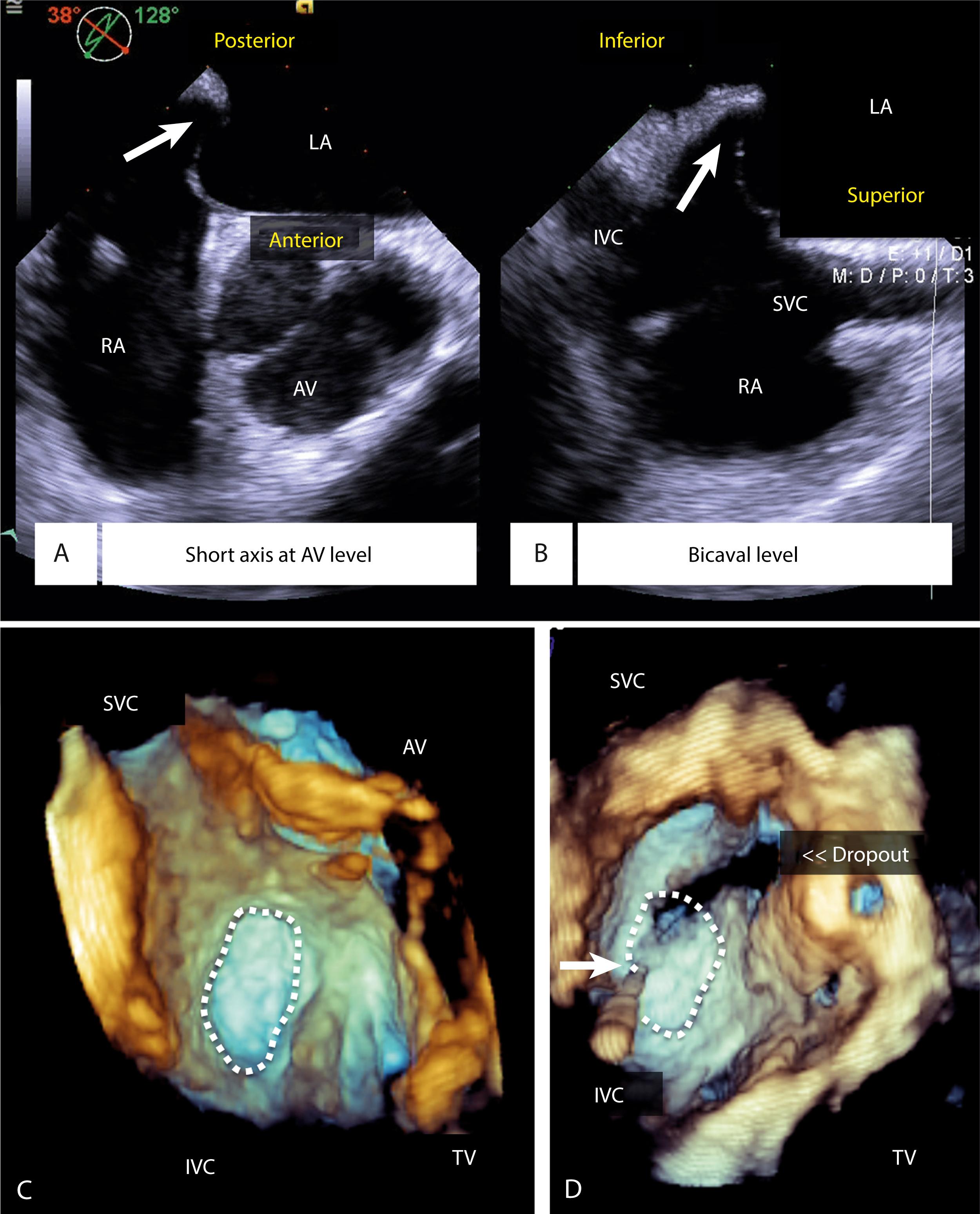 Figure 171.1, Two-dimensional transesophageal echocardiography (TEE) images with biplane imaging demonstrate the interatrial septum in the midesophageal short-axis and bicaval views during the transseptal puncture portion of a left atrial appendage (LAA) occlusion procedure ( A and B ). Note the tenting in the inferior and posterior portion of the fossa ovalis, which is the ideal location for puncture. ( Videos 171.1A and 171.B correspond to A and B .) Three-dimensional TEE of the interatrial septum from the right atrial perspective at baseline before transseptal puncture ( C ) and after transseptal puncture ( D ). This view demonstrates the anatomic location of the fossa ovalis (white dotted circles) at baseline ( C ) and catheter-related dropout ( D ). AV, Aortic valve; LA, left atrium; IVC, inferior vena cava; PA, pulmonary artery; RA, right atrium; SVC, superior vena cava; TV, tricuspid valve.