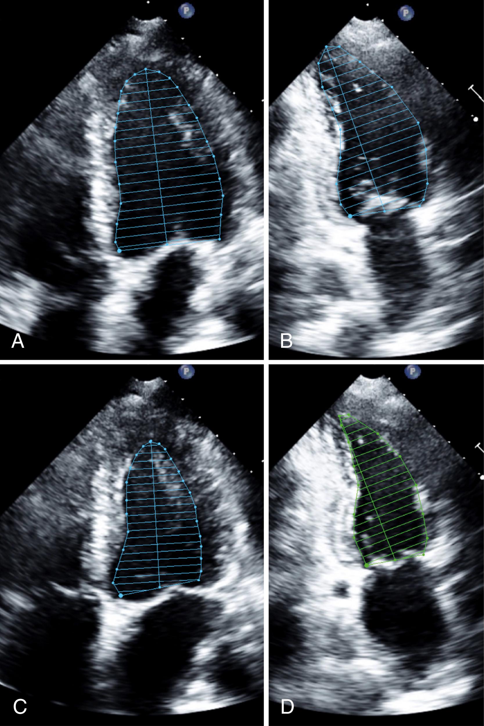 Figure 67.2, Left ventricular volumes and ejection fraction evaluation by biplane method of disks. Manual tracing of endocardial border is performed at end-systole ( C and D ) and diastole ( A and B ) in the apical two- and four-chamber views. The method uses calculation of volume of 20 disks of equal thickness to estimate ventricular volumes. The length of the left ventricle is critical for this calculation; therefore, avoiding foreshortening of the left ventricle becomes critical for its accuracy.