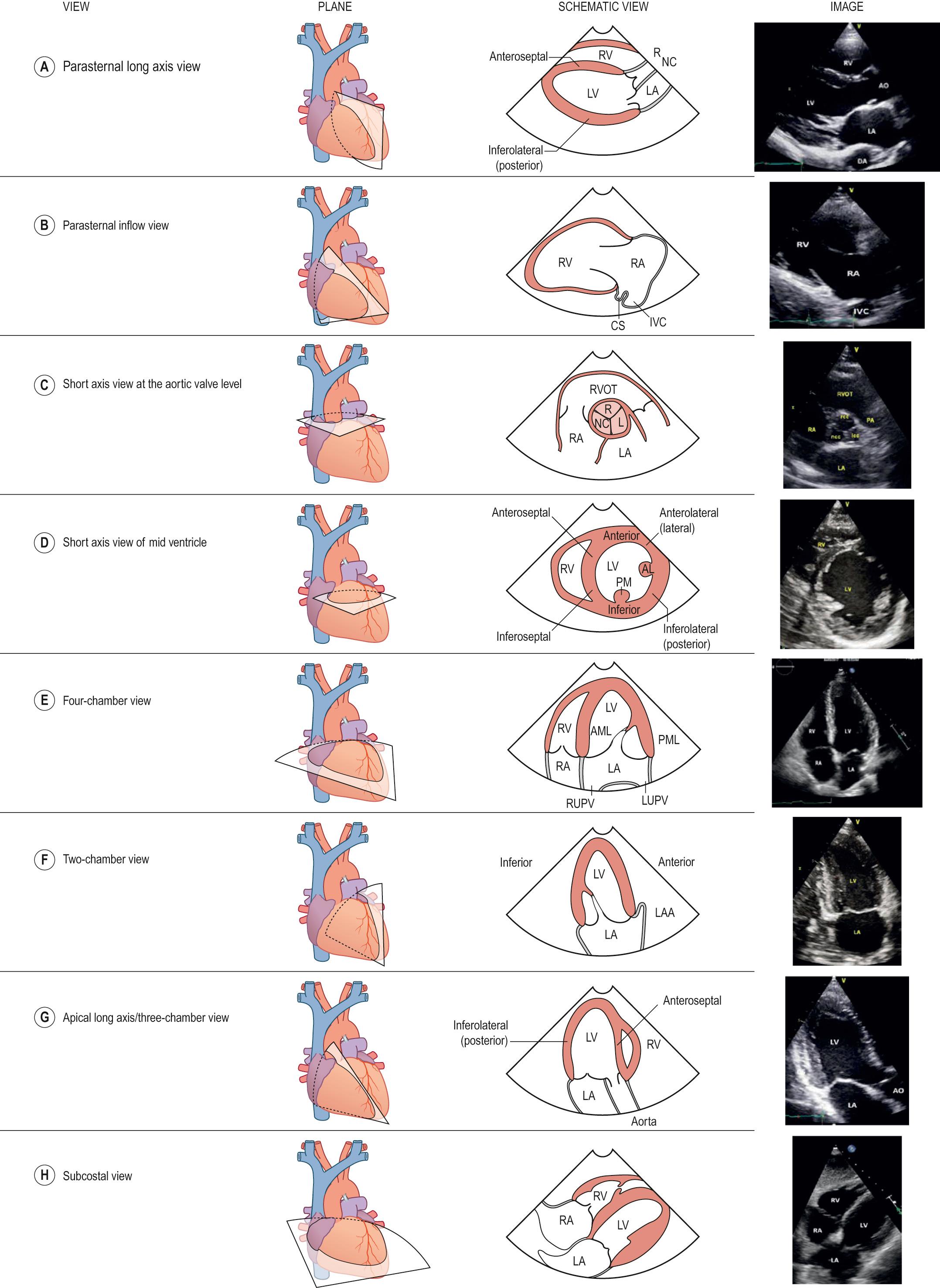 Fig. 50.1, Principal transthoracic views. Abbreviations: AL, anterolateral papillary muscle; AML, anterior mitral leaflet; AO, aorta; CS, coronary sinus; DA, descending aorta; IVC, inferior vena cava; L, left coronary cusp; LA, left atrium; LAA, left atrial appendage; LUPV, left upper pulmonary vein; LV, left ventricle; NC, non-coronary cusp; PM, posteromedial papillary muscle; PML, posterior mitral leaflet; R, right coronary cusp; RA, right atrium; RUPV, right upper pulmonary vein; RV, right ventricle; RVOT, right ventricular outflow.