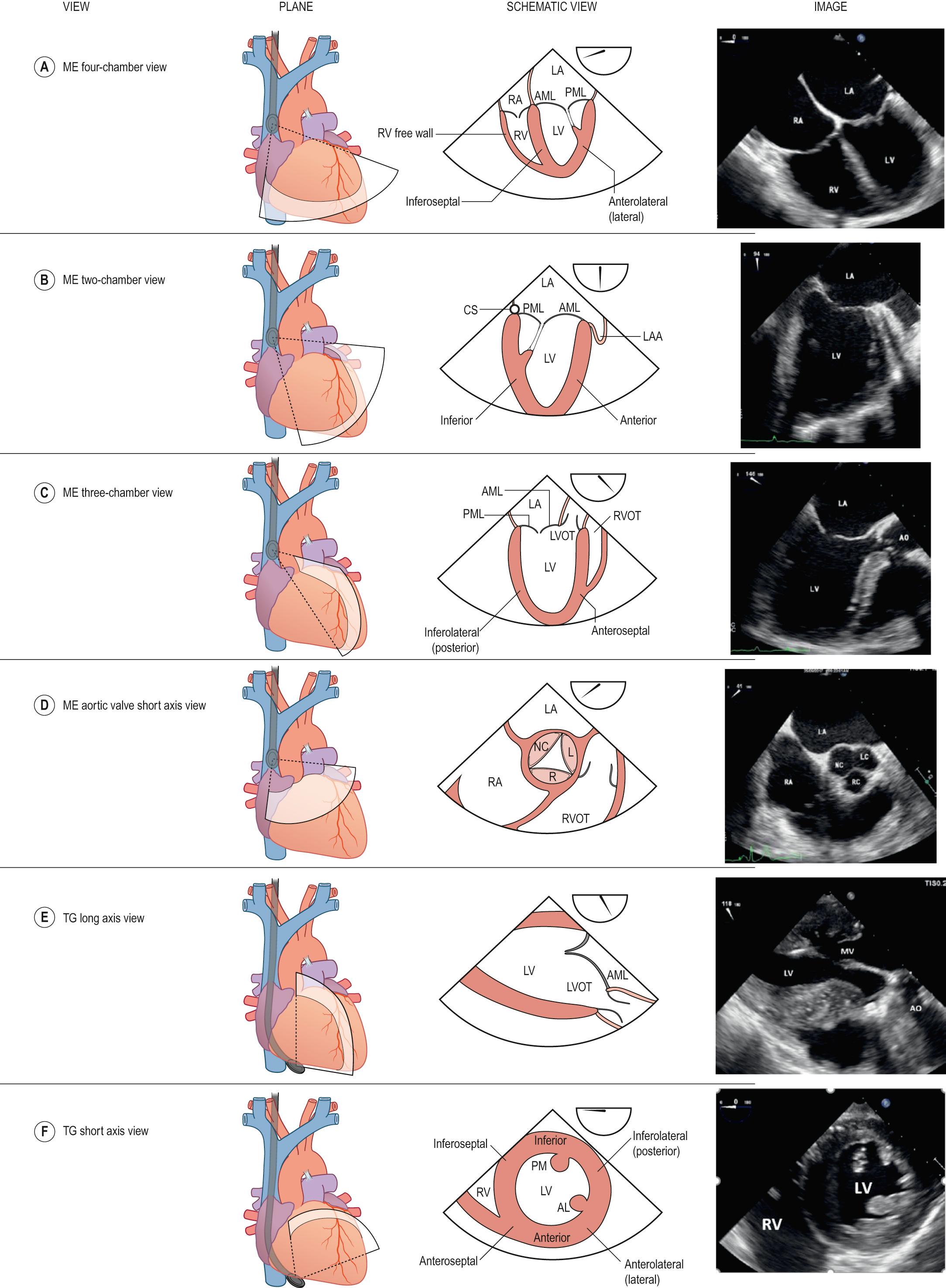 Fig. 50.2, Principal transoesophageal views. Abbreviations: AL, anterolateral papillary muscle; AML, anterior mitral leaflet; AO, aorta; CS, coronary sinus; L, left coronary cusp; LA, left atrium; LAA, left atrial appendage; LV, left ventricle; LVOT, left ventricular outflow; ME, mid-oesophageal; NC, non-coronary cusp; PM, posteromedial papillary muscle; PML, posterior mitral leaflet; R, right coronary cusp; RA, right atrium; RV, right ventricle; RVOT, right ventricular outflow; TG, transgastric.