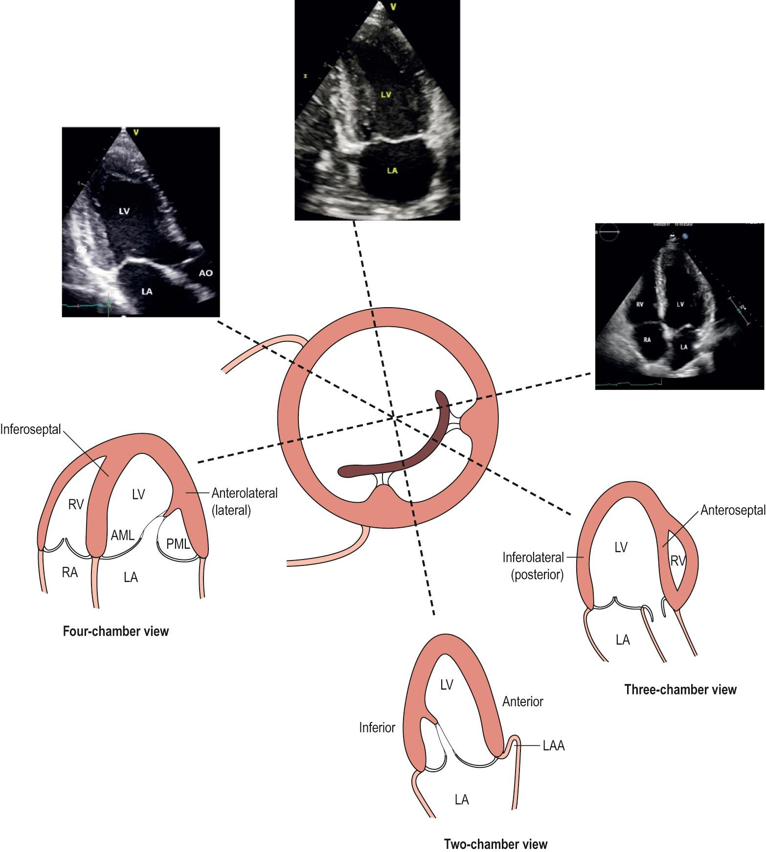 Fig. 50.3, Regional anatomy and imaging planes of the left ventricle in relation to the short axis views. Abbreviations: AML, anterior mitral leaflet; LA, left atrium; LAA, left atrial appendage; LV, left ventricle; PML, posterior mitral leaflet; RA, right atrium; RV, right ventricle.