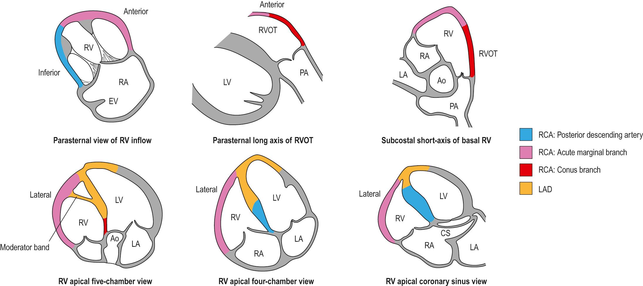 Fig. 50.4, Segmental nomenclature of the right ventricular walls, along with their coronary supply. Abbreviations: Ao, aorta; CS, coronary sinus; EV, Eustachian valve; LA, left atrium; LAD, left anterior descending artery; LV, left ventricle; PA, pulmonary artery; RA, right atrium; RCA, right coronary artery; RV, right ventricle; RVOT, right ventricular outflow tract.