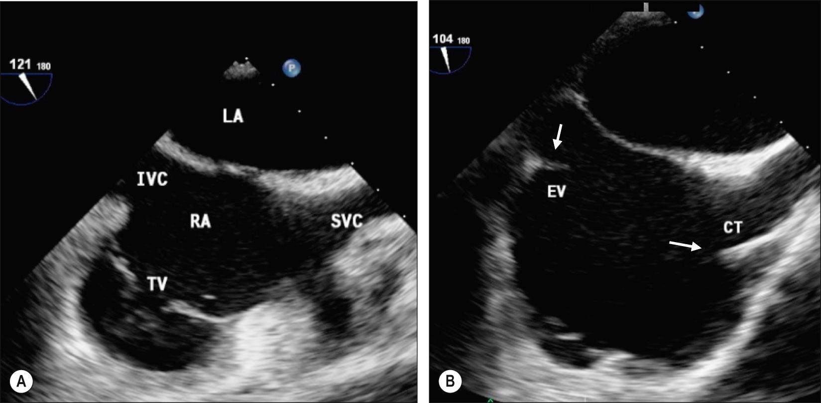 Fig. 50.5, A , A mid-oesophageal bicaval view. Abbreviations: IVC, inferior vena cava; LA, left atrium; RA, right atrium; SVC, superior vena cava; TV, tricuspid valve. B , A mid-oesophageal bicaval view showing a prominent crista terminalis (CT) and Eustachian valve (EV).