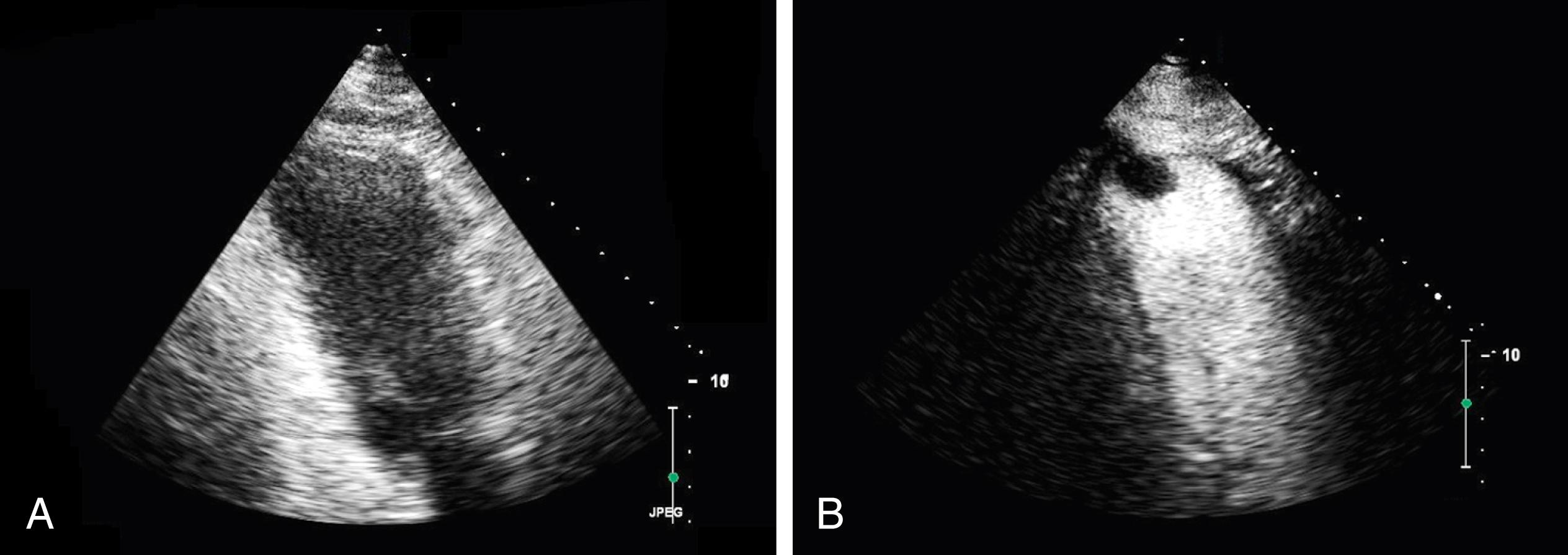 Figure 43.1, Apical views of noncontrast ( A ) and contrast ( B ) transthoracic echocardiography. Note the anteroapical regional wall motion abnormalities and the demonstration of a filling defect at the left ventricular apex by contrast echocardiography (right) , consistent with a left ventricular apical thrombus measuring 1.5 × 2.3 cm. (See corresponding Video 43.1a , Video 43.1b .)