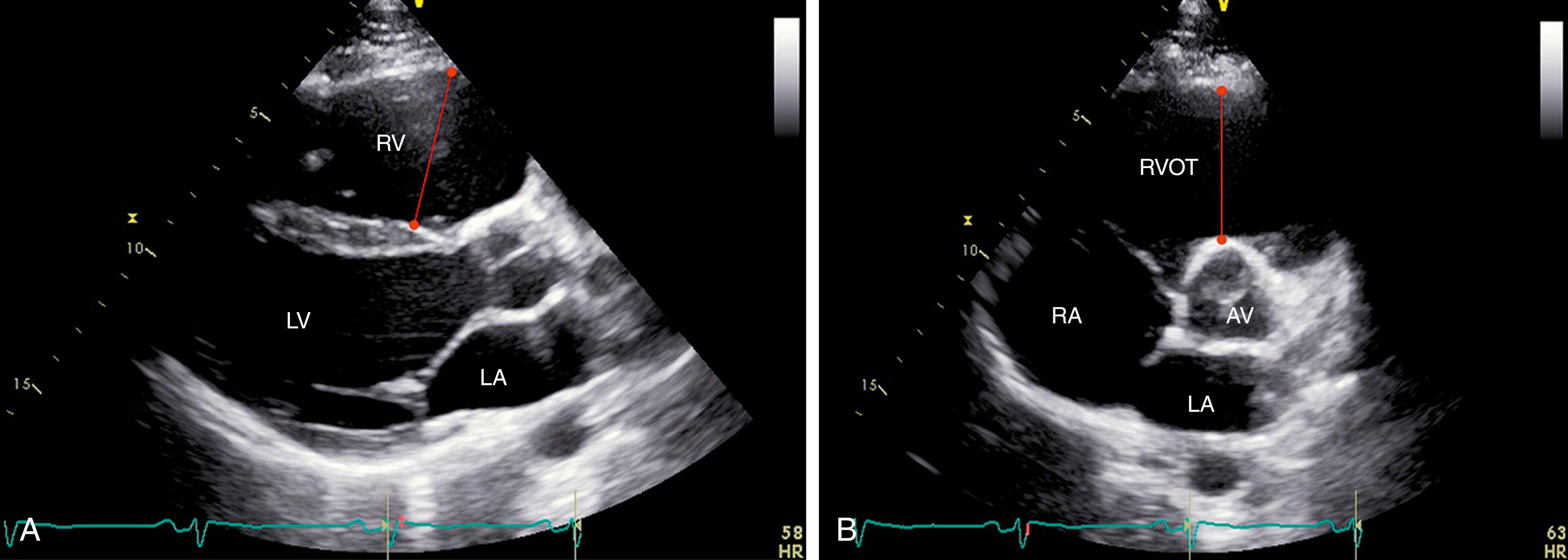 Figure 74.1, Measurement of right ventricular outflow tract (RVOT) dimensions on two-dimensional echocardiography in arrhythmogenic right ventricular cardiomyopathy in the parasternal long-axis ( A ) and parasternal short-axis ( B ) views. AV, Aortic valve; LA, left atrium; LV, l eft ventricle; RA, right atrium.