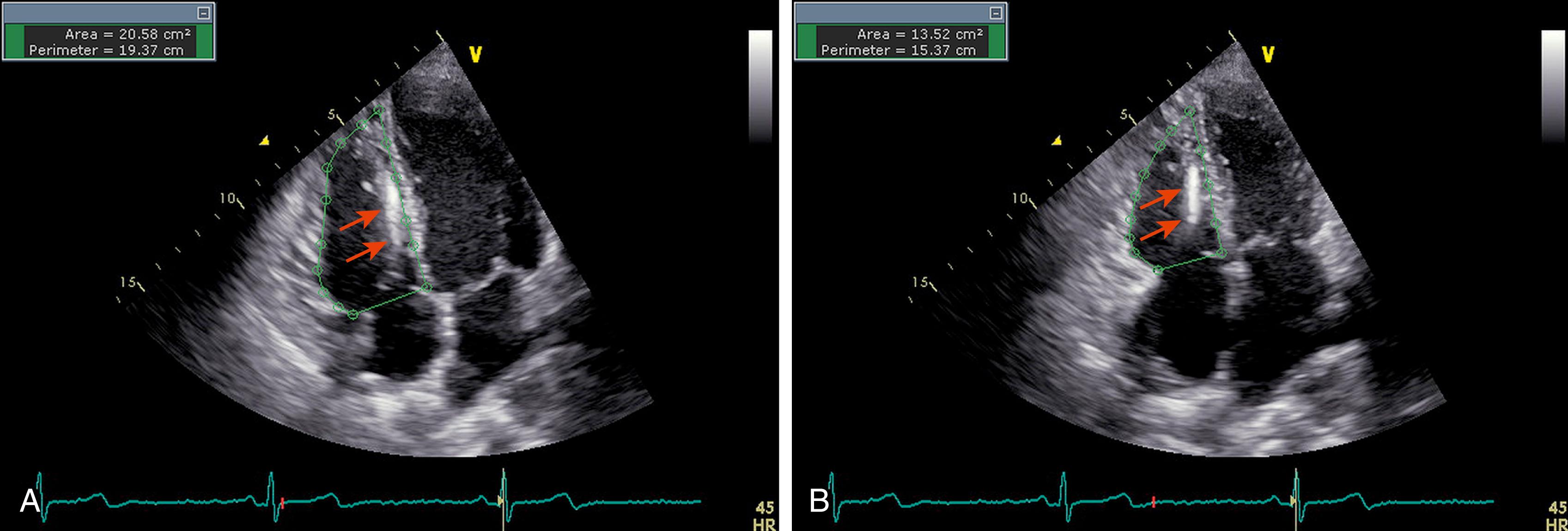 Figure 74.2, Measurement of fractional area change (FAC) of the right ventricle in a patient with known arrhythmogenic right ventricular cardiomyopathy using end-diastolic ( A ) and end-systolic ( B ) areas. FAC is calculated as the ratio of the difference between end-diastolic area (EDA) and end-systolic area (ESA) to EDA (i.e., FAC = [EDA-ESA]/EDA). It is important to carefully delineate pacemaker or implantable cardioverter-defibrillator wires (arrows) from the endocardial border of the right ventricle.