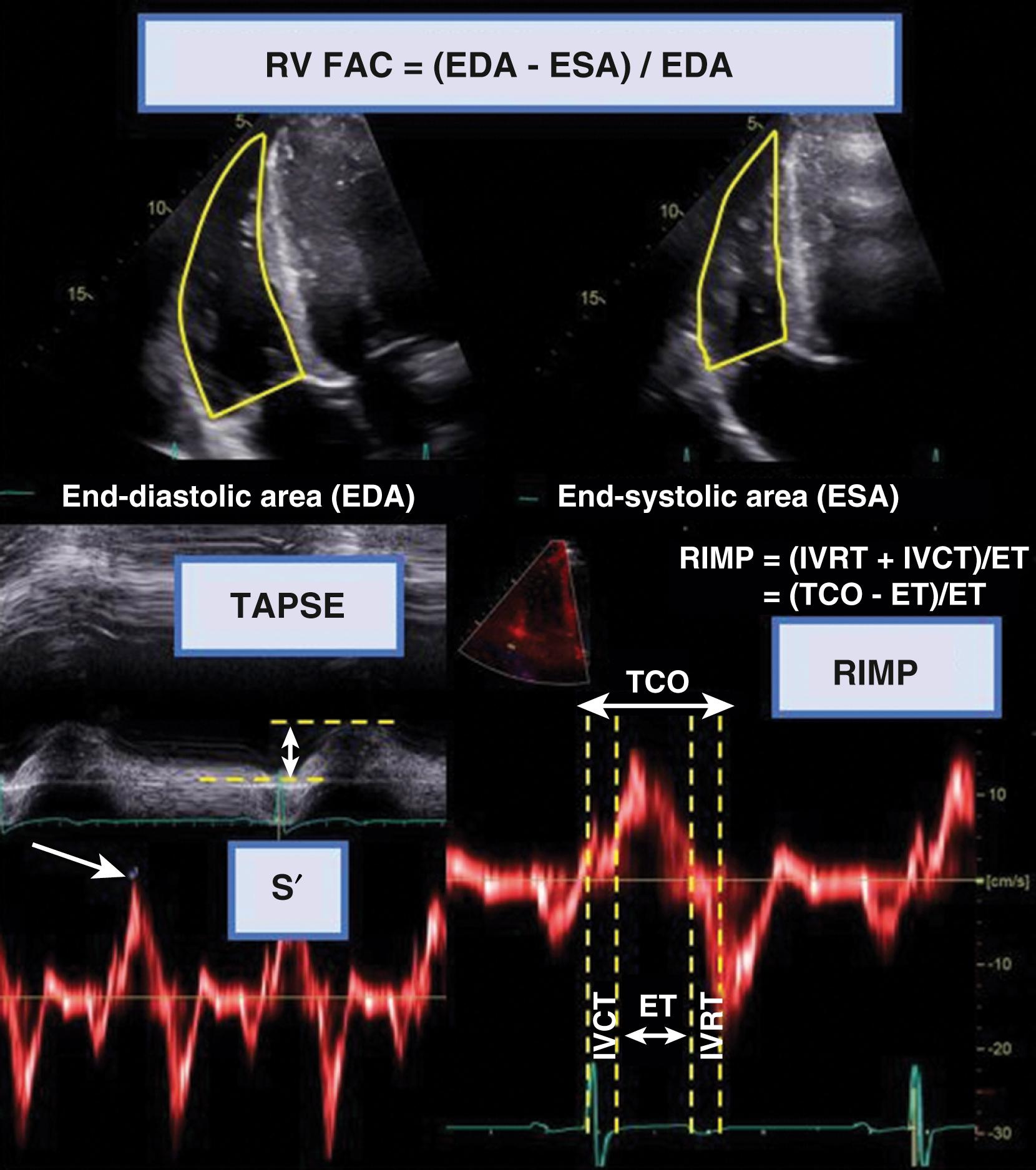 Figure 77.1, Standard two-dimensional echocardiographic methods of assessing right ventricular (RV) systolic function, including fractional area change (FAC), tricuspid annular plane systolic excursion (TAPSE), S′ tissue Doppler, and right ventricular index of myocardial performance (RIMP). ET, Ejection time; IVCT, isovolumic contraction time; IVRT, isovolumic relaxation time; TCO, tricuspid closure-open time.