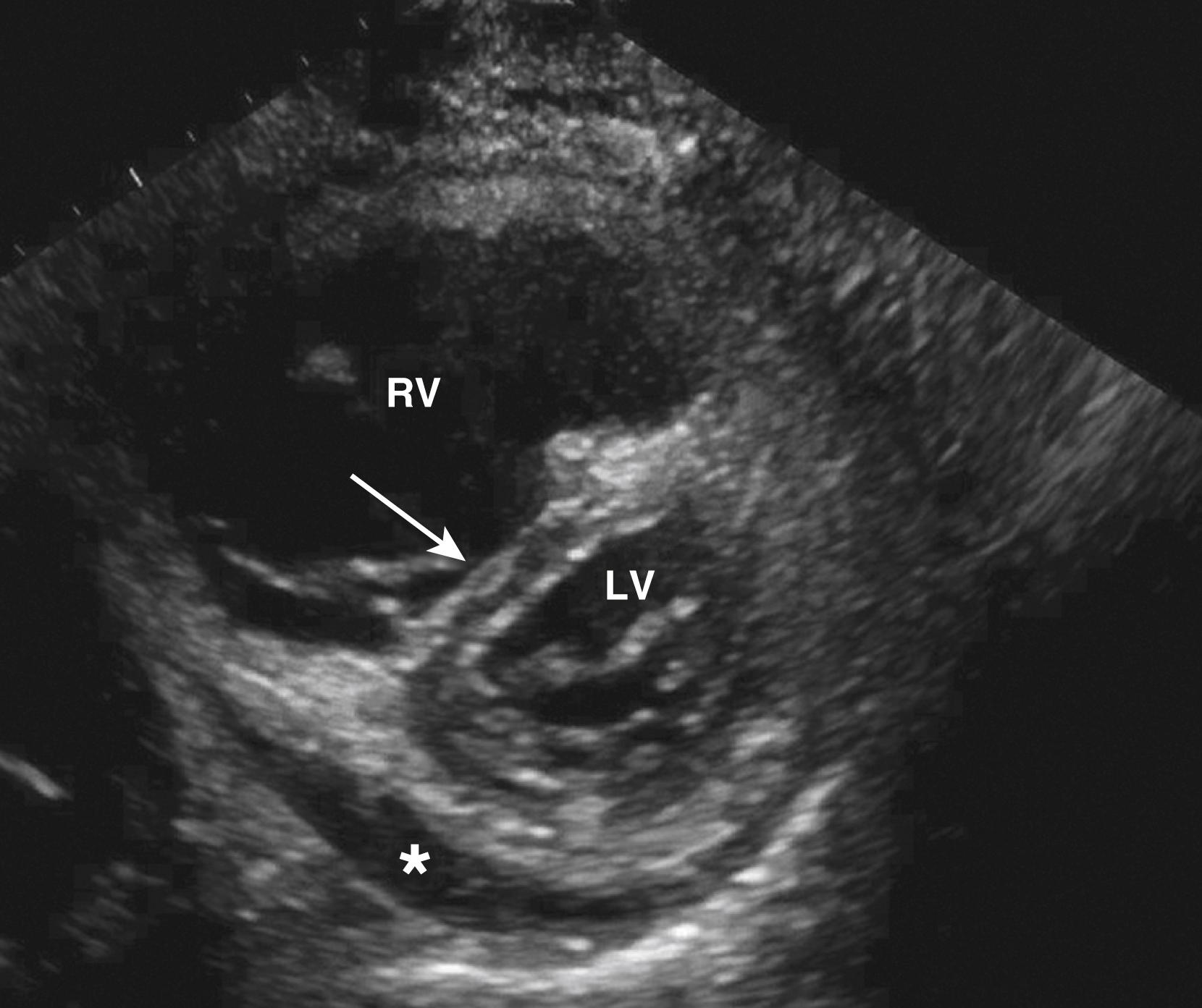 Figure 77.2, Basal parasternal short-axis view of a patient with severe pulmonary arterial hypertension. Note the severe dilatation of the right ventricle (RV), septal flattening (arrow) , and presence of a pericardial effusion (asterisk) . LV, Left ventricle. (See accompanying Video 77.2 .)