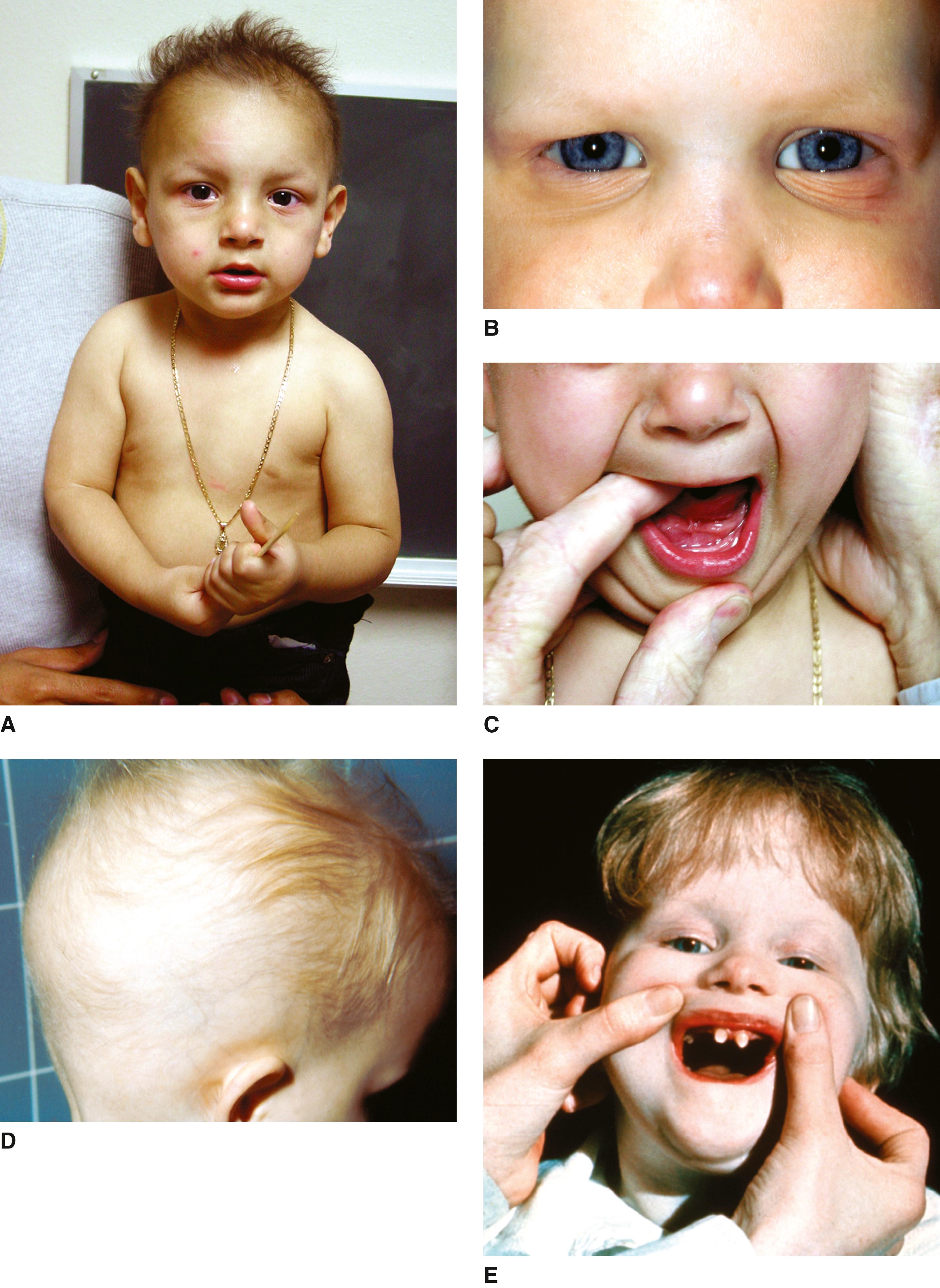 FIGURE 1, Hypohidrotic ectodermal dysplasia.