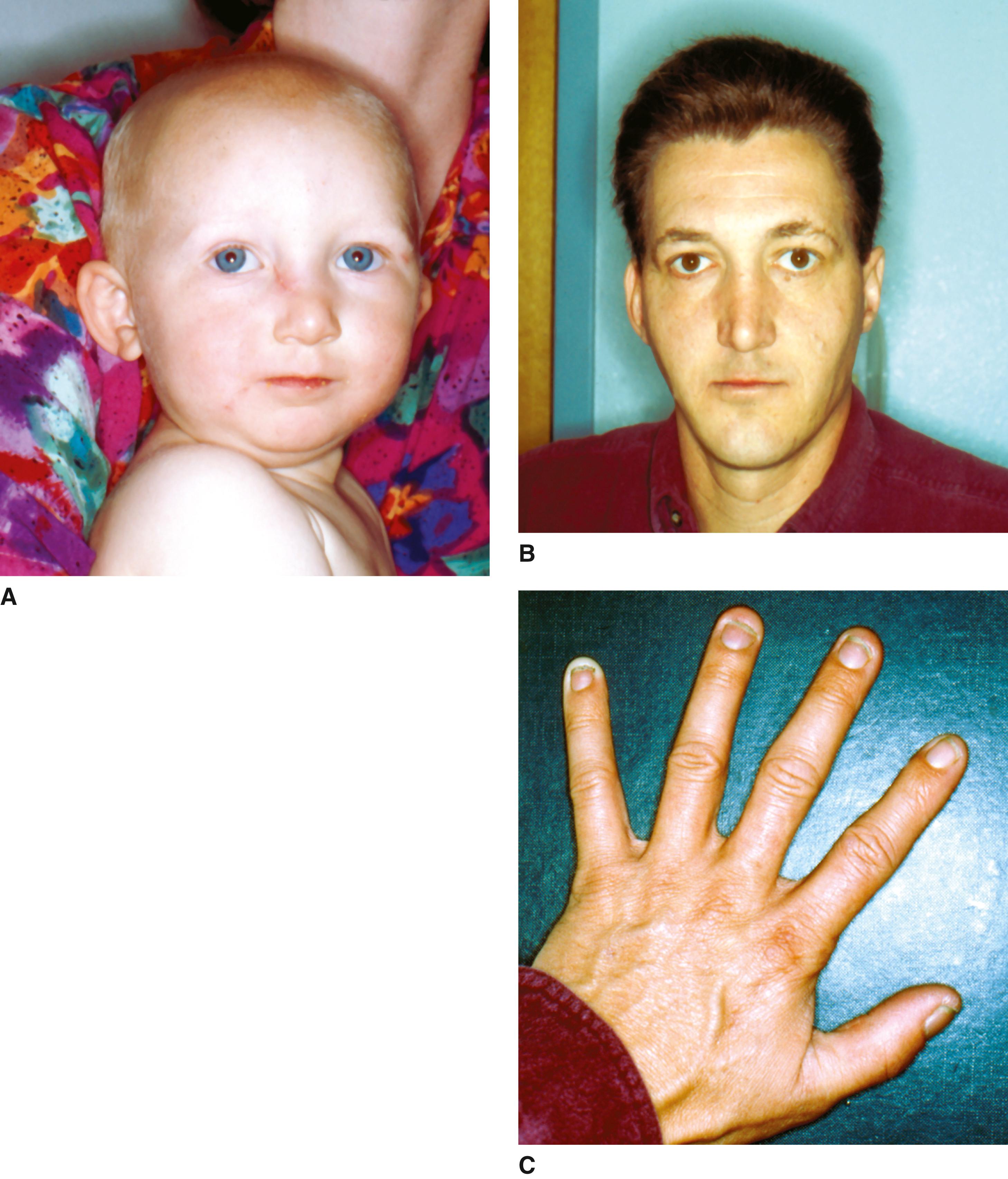 FIGURE 1, Rapp-Hodgkin ectodermal dysplasia.