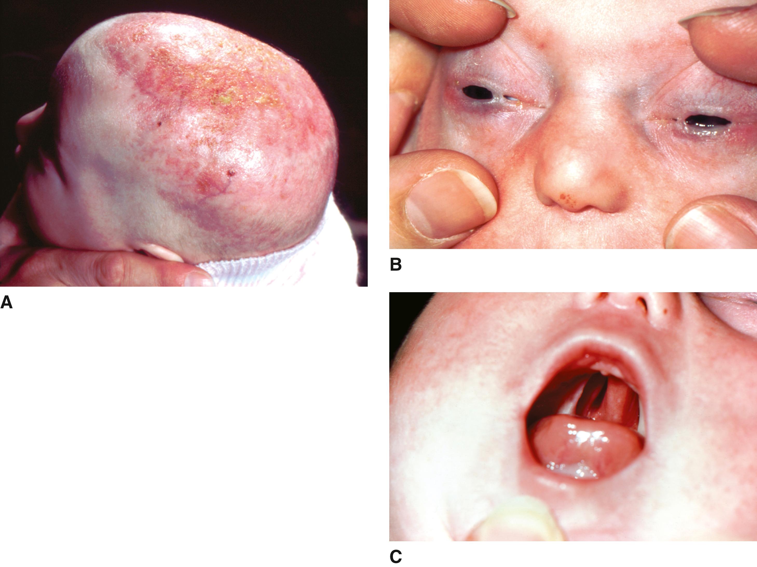 FIGURE 2, Hay-Wells Syndrome. A–C. Ectodermal dysplasia with folliculitis of scalp, adhesions between eyelids, and cleft palate.