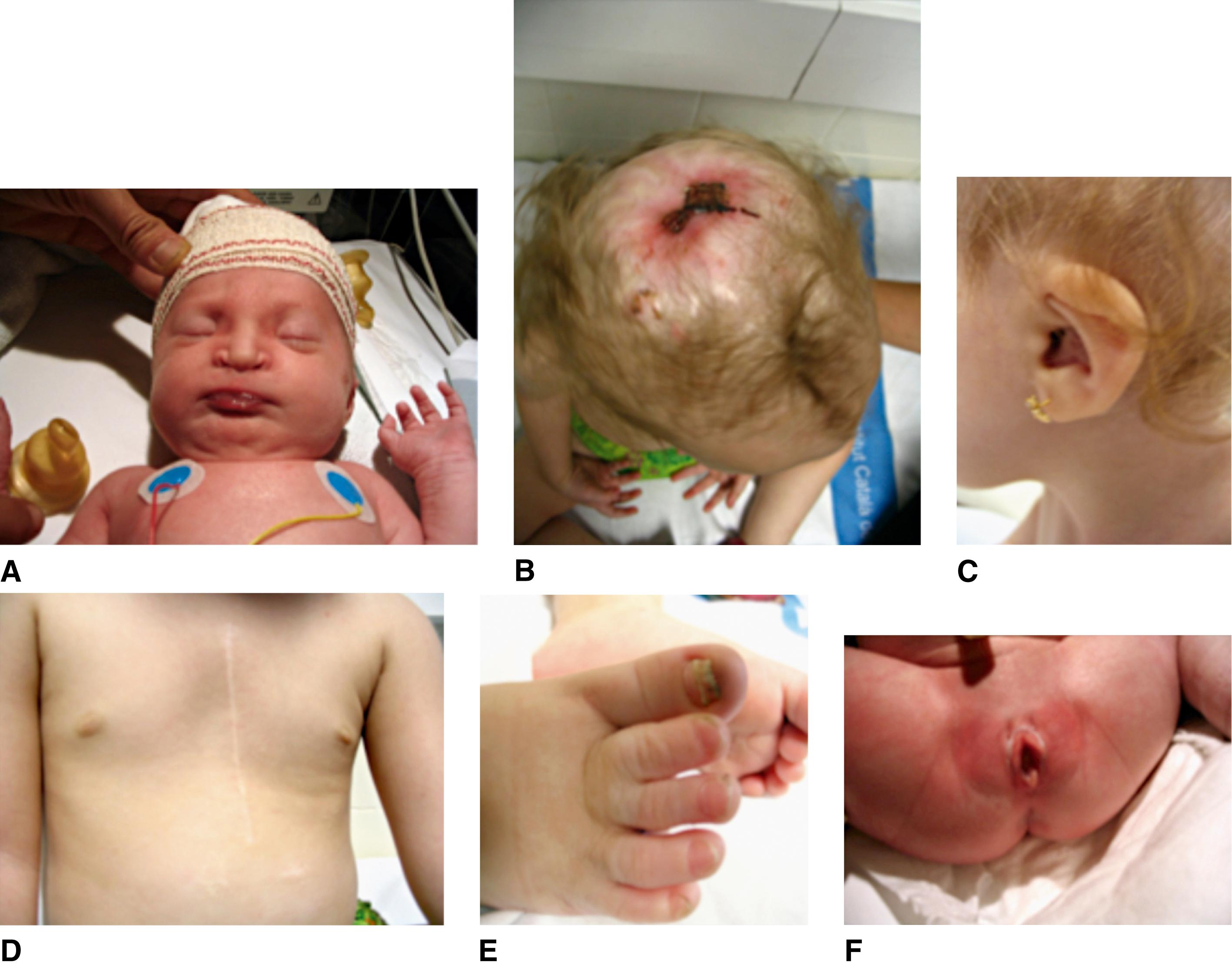 FIGURE 1, Finlay-Marks syndrome.