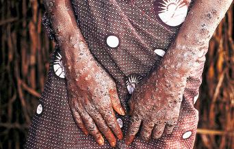 Fig. 5.11, Chronic eczematous scabies in a Gambian woman.