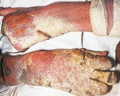 Fig. 5.12, Hyperkeratotic (‘Norwegian’) scabies in a patient who had suffered a 70% burn injury.