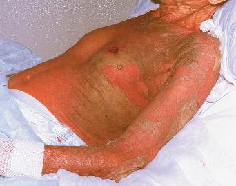 Fig. 5.13, ‘Norwegian’ scabies in an elderly man.