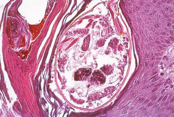 Fig. 5.14, Section of biopsy from patient with 'Norwegian' scabies.