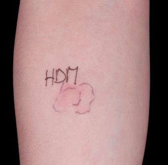 Fig. 5.5, Skin test for hypersensitivity to house dust mite.