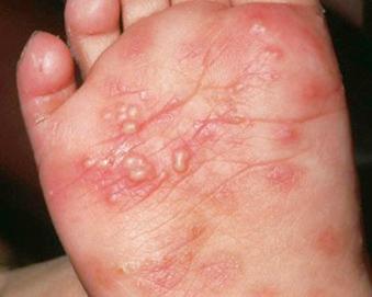 Fig. 5.8, Scabies burrows, papules and vesicopustules on the foot of an infant.