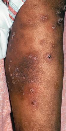 Fig. 5.10, Secondary erythema in scabies.