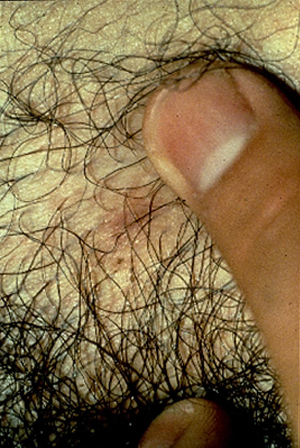 FIGURE 257.1, Maculae cerulae caused by the bite of the body louse.