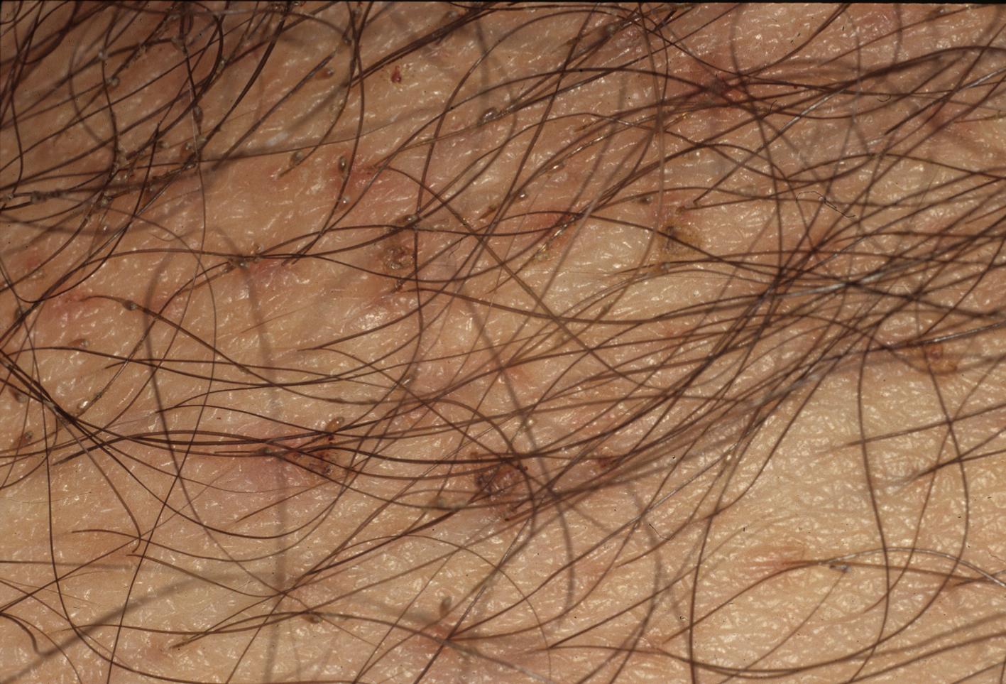 FIGURE 257.5, Crab lice in pubic hair.