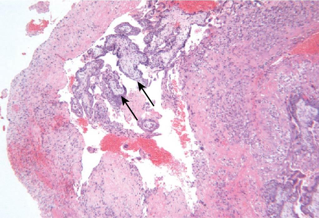 Fig. 17.1, Histologic results of ectopic pregnancy. Note the trophoblastic tissue (arrows) in the fallopian tube lumen.