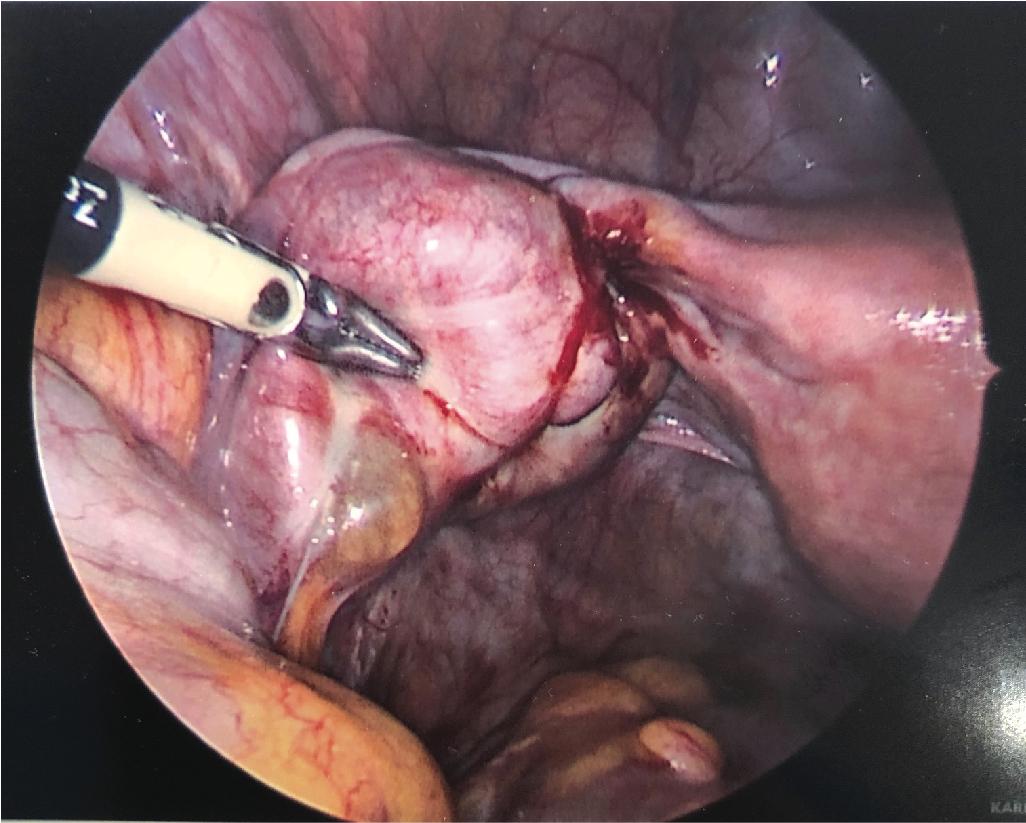 Fig. 17.2, Left ovarian endometrioma behind clubbed left tube with hydrosalpinx and adjacent bowel adhesions.