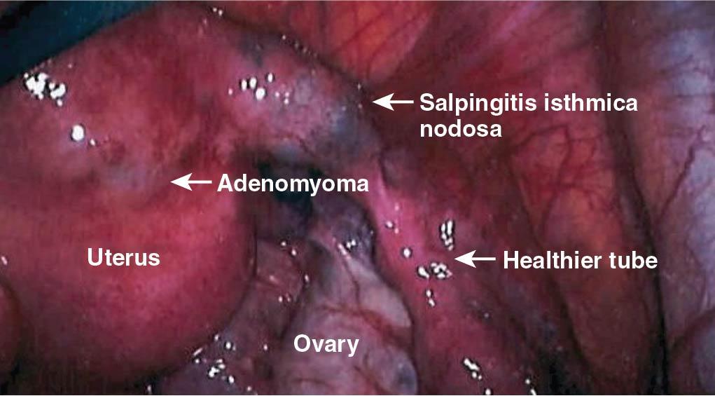 Fig. 17.3, Laparoscopic view of salpingitis isthmica nodosa in the isthmic tube and cornual regions of the uterus. Note the normal distal tube.