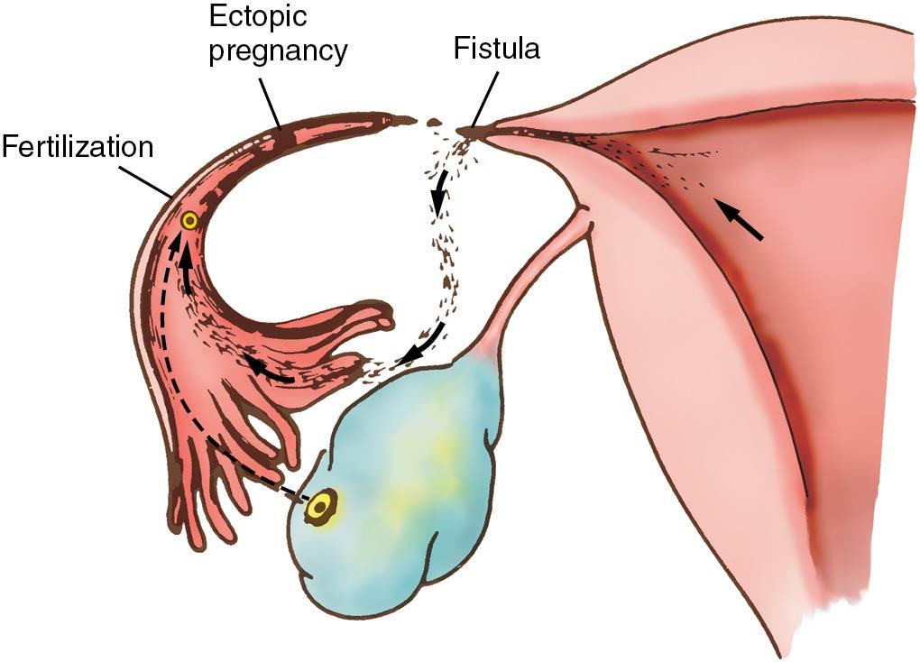 Fig. 17.4, Mechanism of ectopic pregnancy after sterilization.