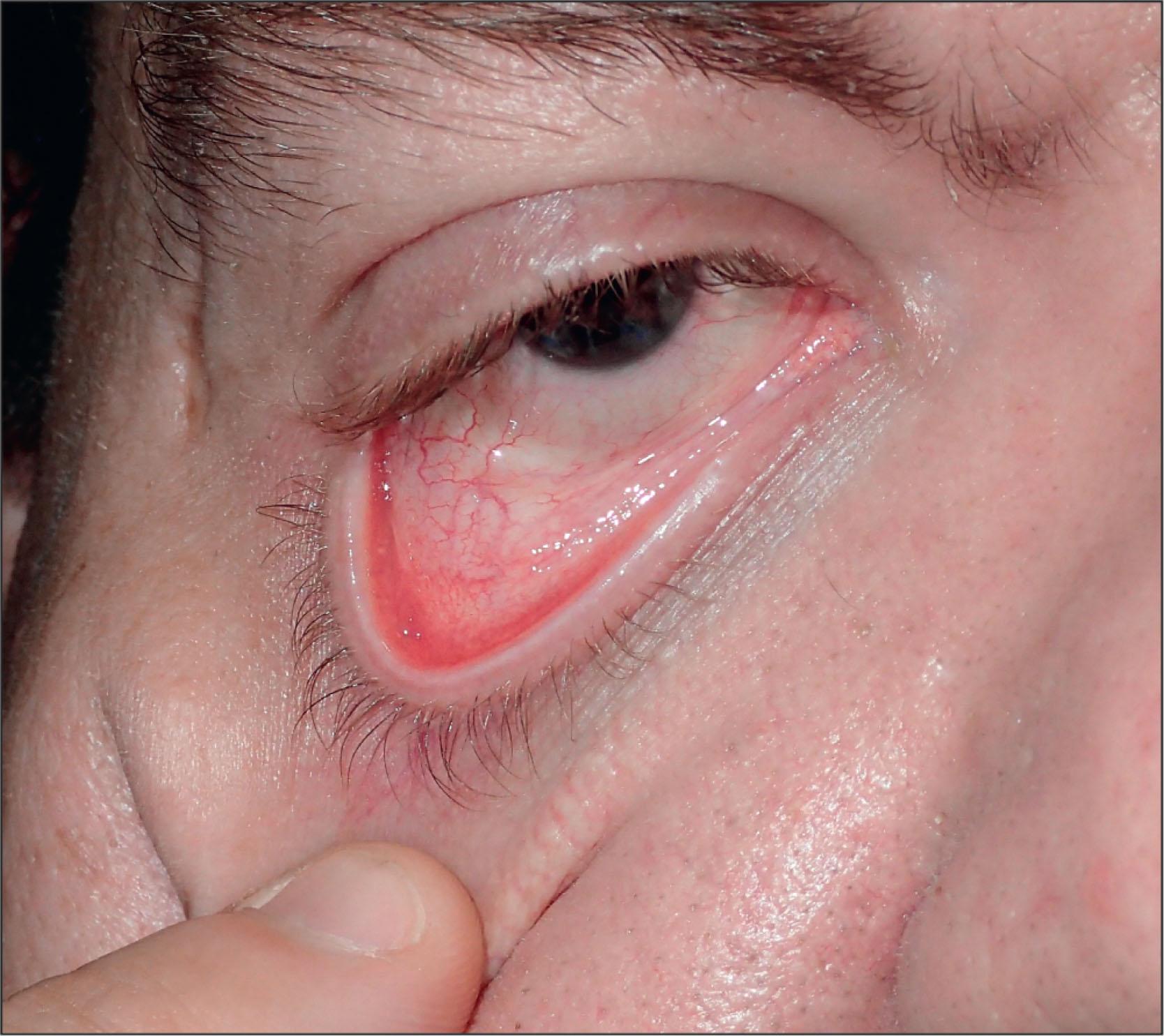 Fig. 12.6.1, Lower Eyelid Distraction Test: The Lower Eyelid Is Pulled From the Globe and the Distance Between the Eyelid Margin and the Globe Can Be Measured.