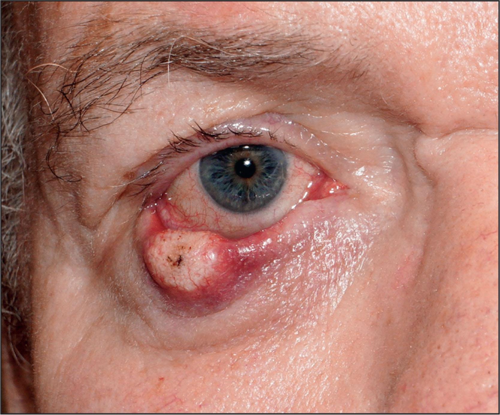 Fig. 12.6.2, Mechanical Ectropion Resulting From a Large Lower-Eyelid Mass (Squamous Cell Carcinoma).