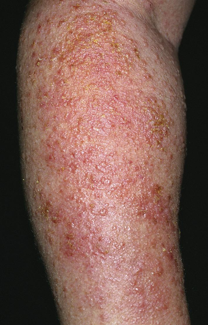 Fig. 2.1, Acute eczema with vesicles, erythema, edema, and weeping.