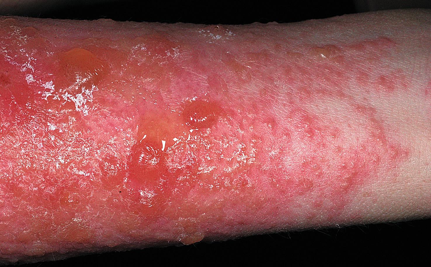 Fig. 2.12, Poison ivy with severe, intense, acute eczematous inflammation and large confluent blisters. Many blisters have ruptured. The serum that leaks onto the skin does not spread poison ivy. Cool wet compresses applied for 30 minutes several times a day help to control the inflammation.