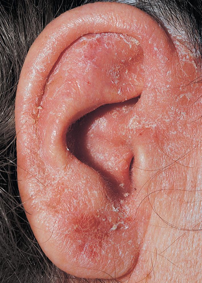 Fig. 2.14, Subacute eczema of the ear with erythema, scaling, and crusting.