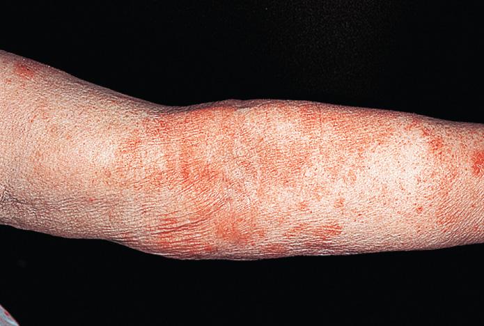 Fig. 2.15, Erythema and scaling with indistinct borders are characteristic. Vesicles may never appear. This is often the initial presentation in the winter in atopic patients.