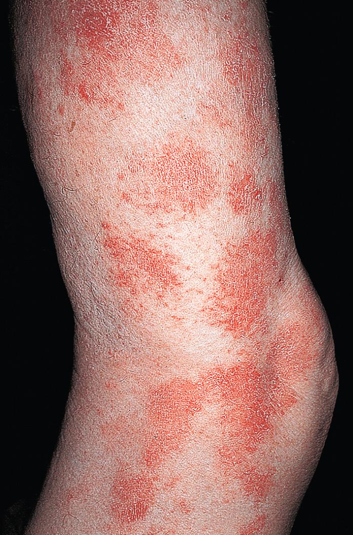 Fig. 2.16, Subacute eczematous inflammation. The configuration of subacute inflammation varies. Plaques may be patchy or confluent, round or diffuse.