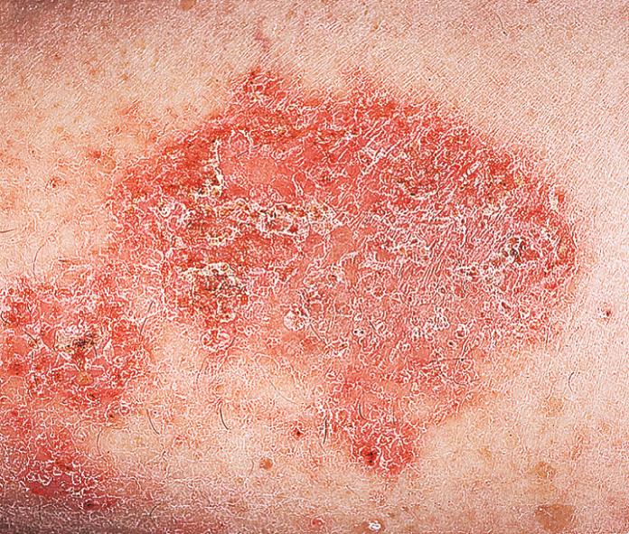 Fig. 2.17, Subacute eczematous inflammation. This plaque is dense and covered with scale. The borders are somewhat distinct. Differentiation from psoriasis in this case would be difficult. The history and types of plaques in other areas may be needed to confirm a diagnosis.